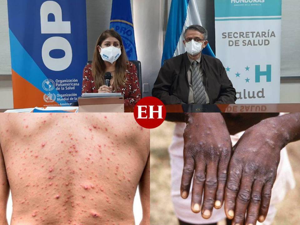 Hasta 21 días de hospitalización a contagiados: las medidas que adoptará Honduras tras primer caso de viruela del mono