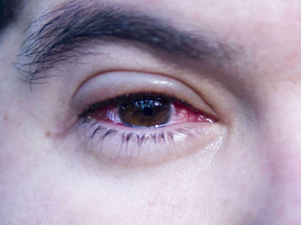 Uno de los principales síntomas es el ojo rojo.